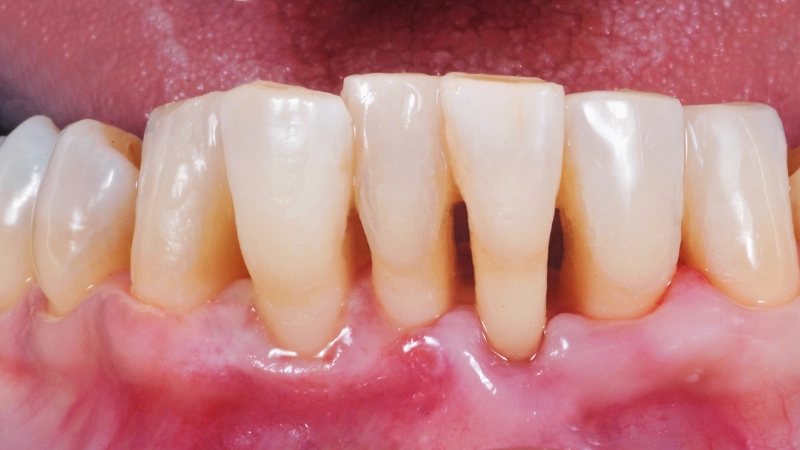 15 bệnh lý răng miệng dễ mắc phải