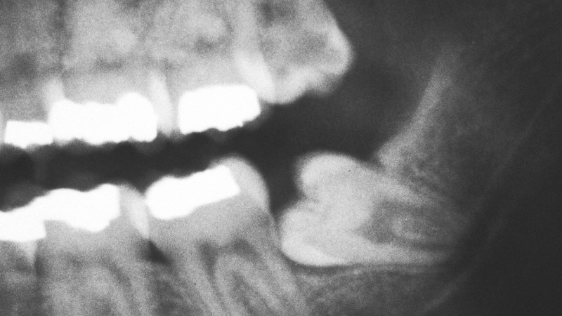15 bệnh lý răng miệng dễ mắc phải