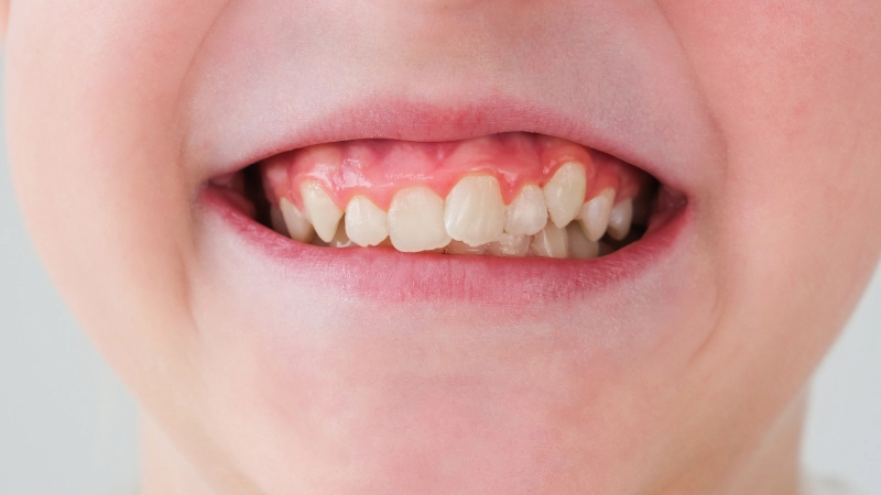 15 bệnh lý răng miệng dễ mắc phải