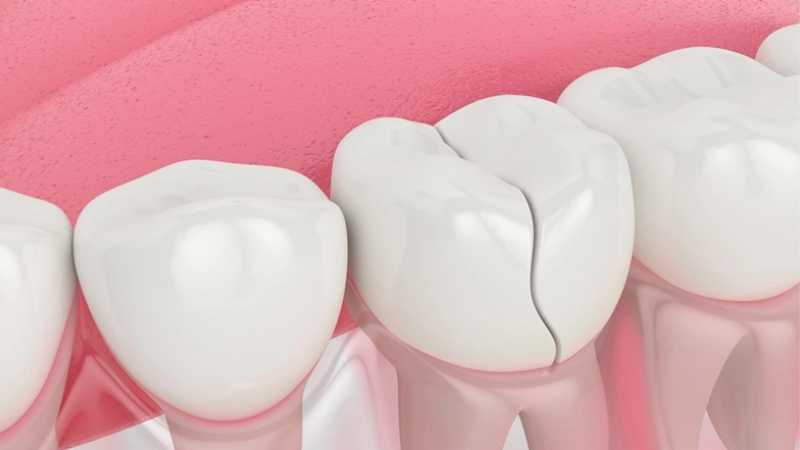 15 bệnh lý răng miệng dễ mắc phải