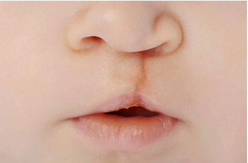 Điều trị khe hở môi - vòm miệng có phải chỉ cần một lần phẫu thuật?