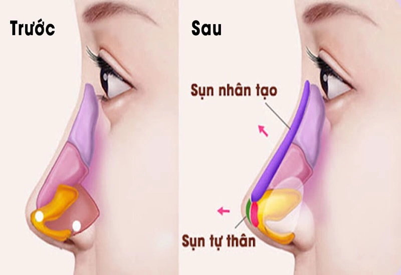 Sụn tự thân thường được lấy từ phần sụn của xương sườn số 6, 7 hoặc 8