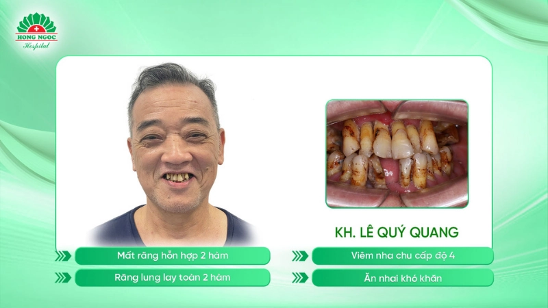 Trồng răng Implant