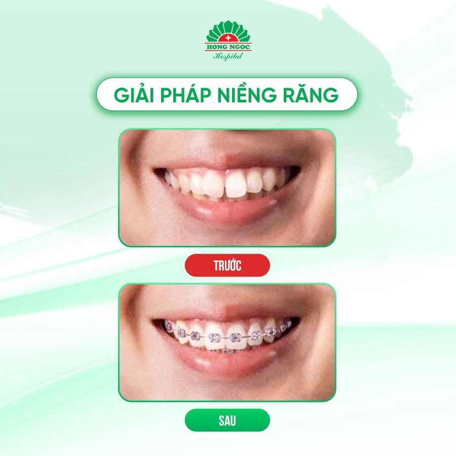 Bác sĩ giỏi - Yếu tố quyết định thành công của một ca niềng