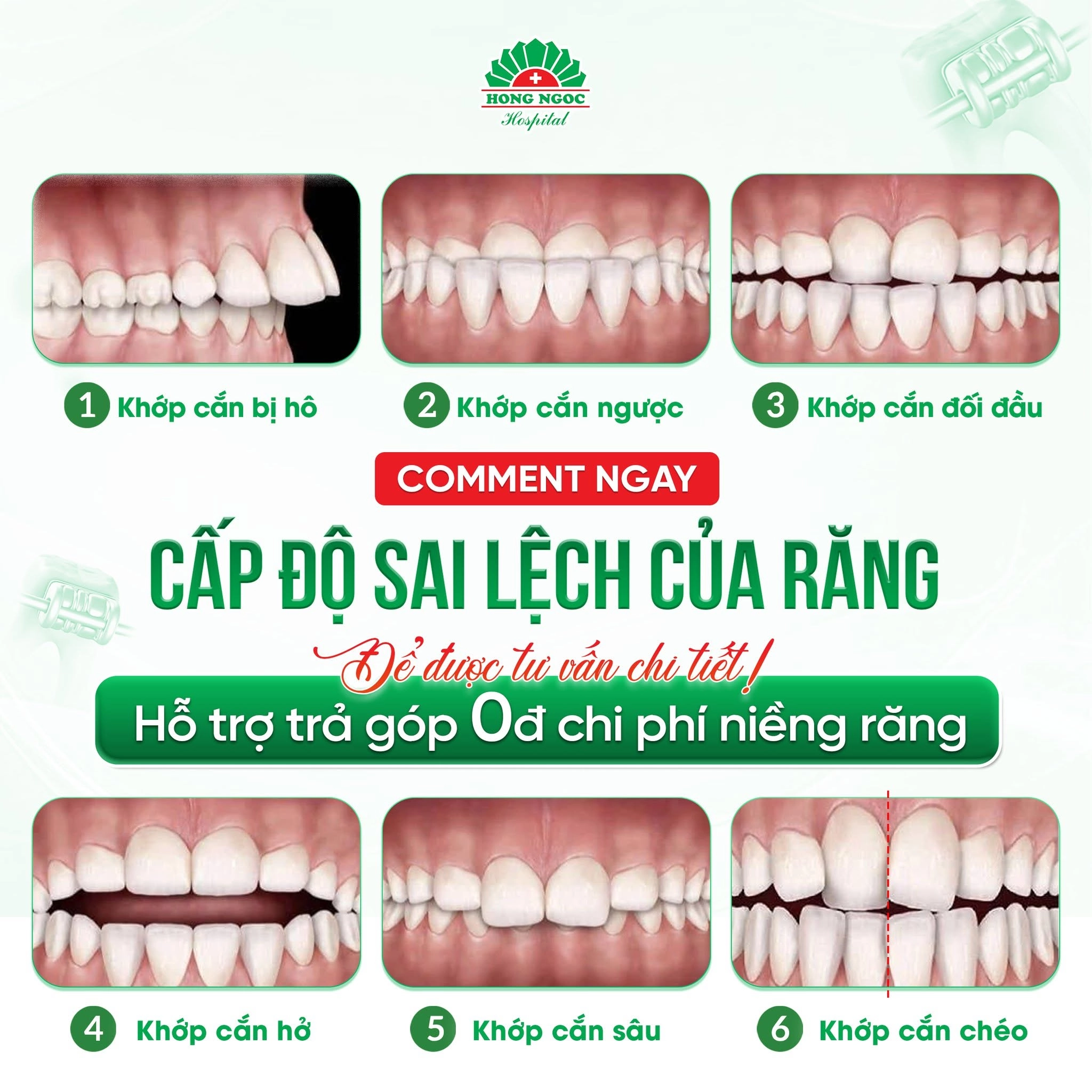 Các tình trạng sai khớp cắn thường gặp