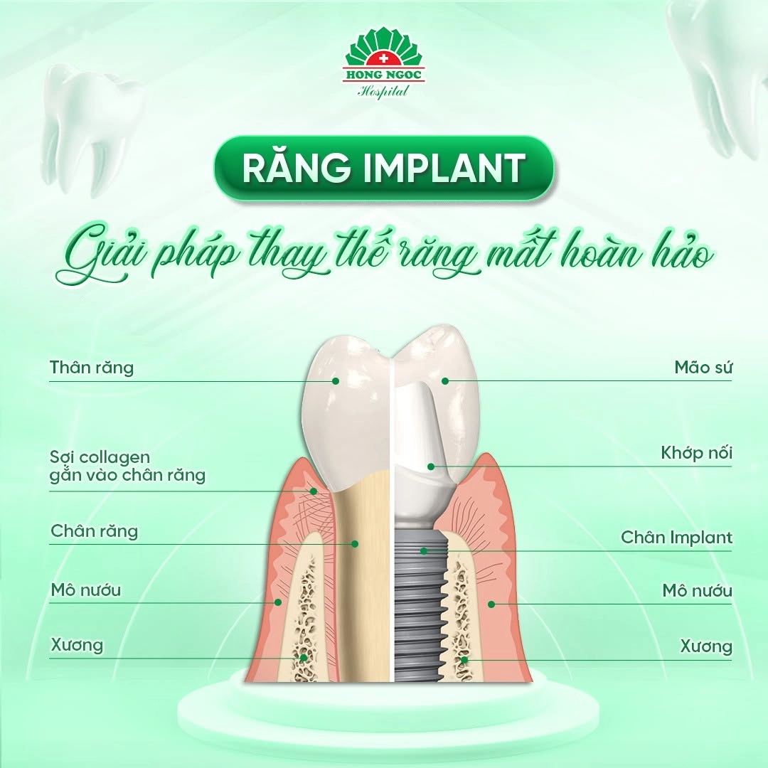 Trồng răng Implant - giải pháp phục hình răng mất như răng thật