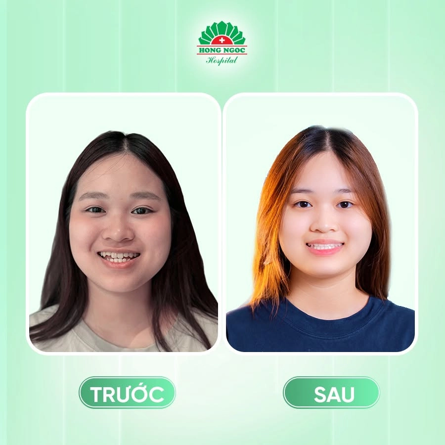 Những trường hợp không nên trì hoãn việc chỉnh nha