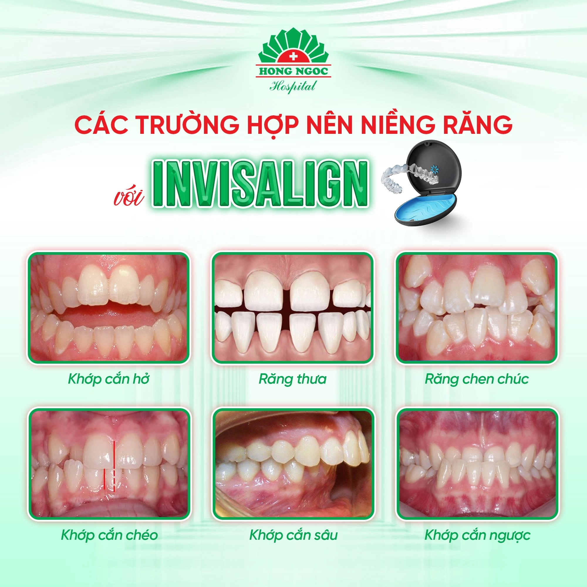 Ai phù hợp với phương pháp niềng răng trong suốt?