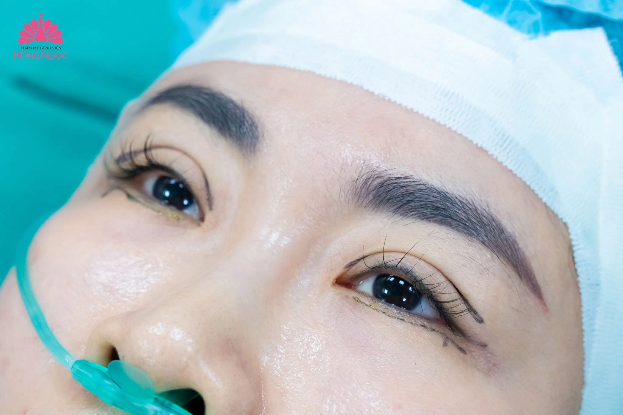 Chi phí lấy mỡ bọng mắt là bao nhiêu?