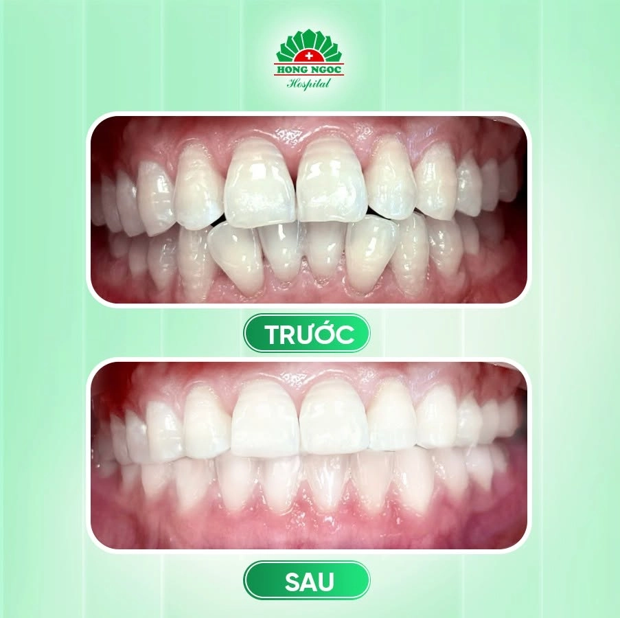 Ưu điểm nổi bật của niềng răng Invisalign phù hợp với người bận rộn