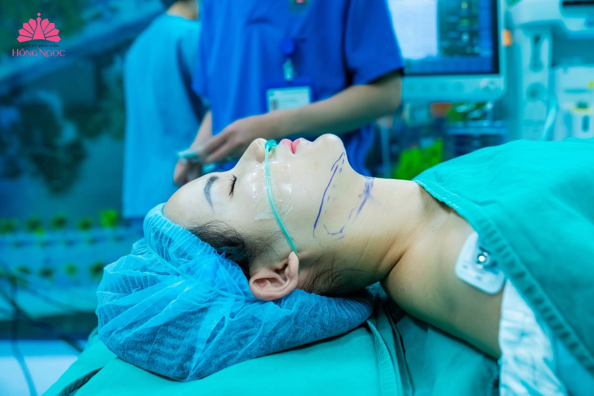 Hút mỡ mặt an toàn bằng công nghệ Vaser Lipo tại Thẩm mỹ Bệnh viện Hồng Ngọc