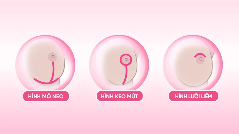 thu gọn ngực phì đại