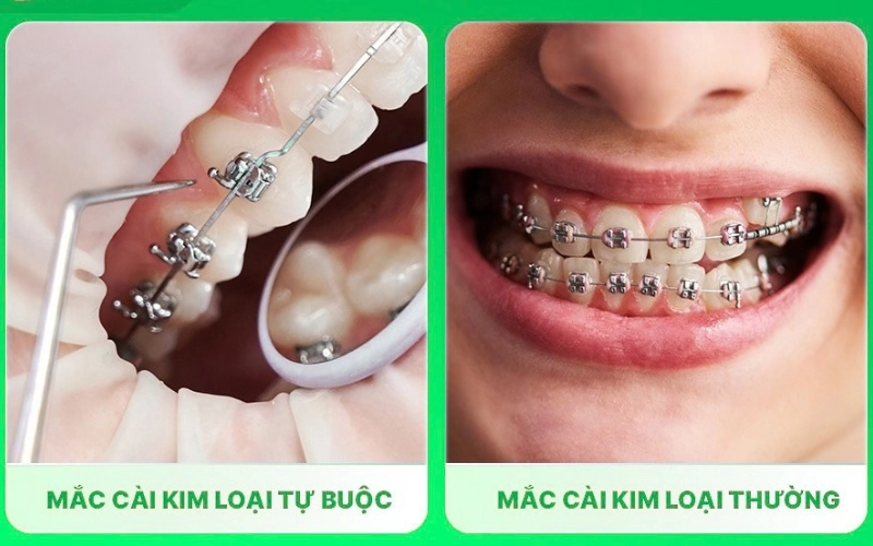 Những ai nên sử dụng mắc cài kim loại