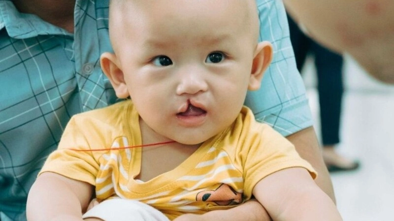 ảnh hưởng của hở hàm ếch