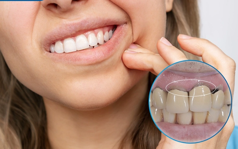 Biến chứng sau khi bọc răng sứ