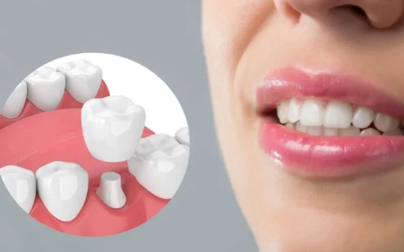 Chăm sóc răng sứ để hạn chế các biến chứng