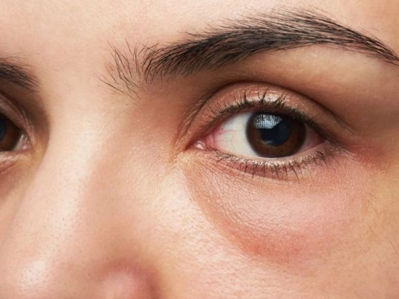 bọng mắt do nguyên nhân khách quan