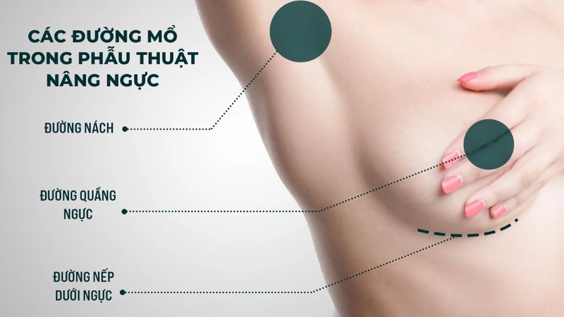 Vị trí các đường rạch trong khi phẫu thuật nâng ngực nội soi