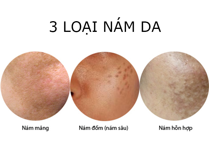 nám da chia thành: nám mảng, nám sâu và nám hỗn hợp