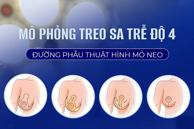 phân loại treo sa trễ đường quầng