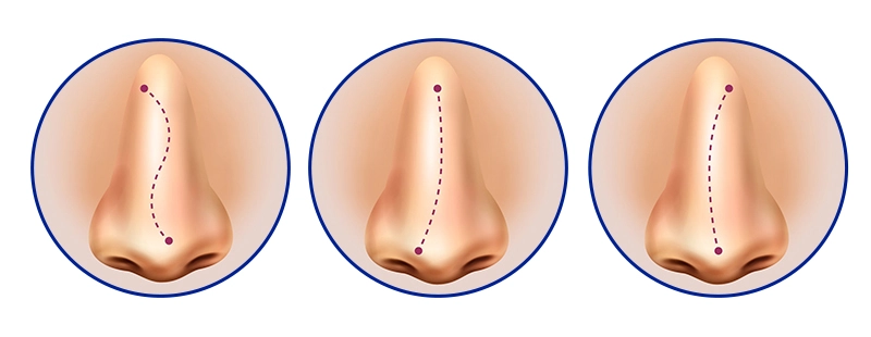 các trường hợp mũi lệch
