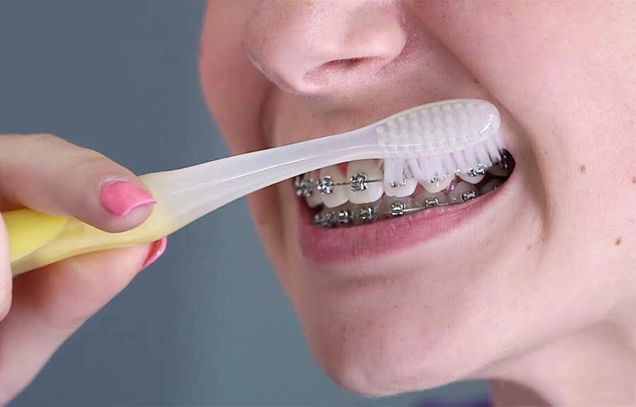 Vì sao phải chăm sóc răng miệng khi niềng răng?