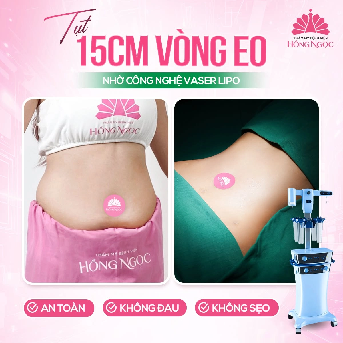 Tụt 15cm vòng eo nhờ công nghệ hút mỡ vaser lipo