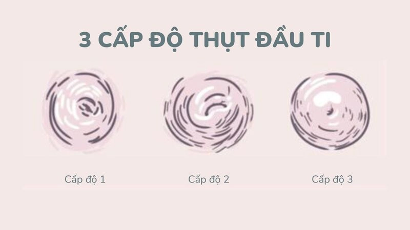 các cấp độ tụt núm vú