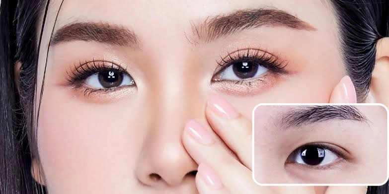 Lấy mỡ bọng mắt qua đường kết mạc
