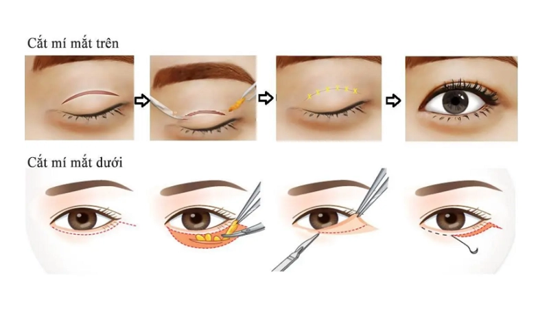 cắt mí