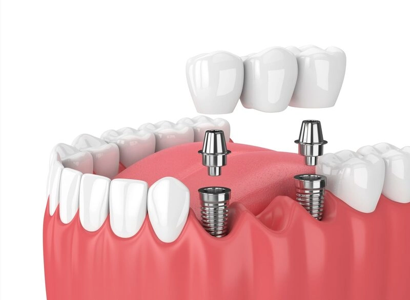 cầu răng sứ trên trụ implant
