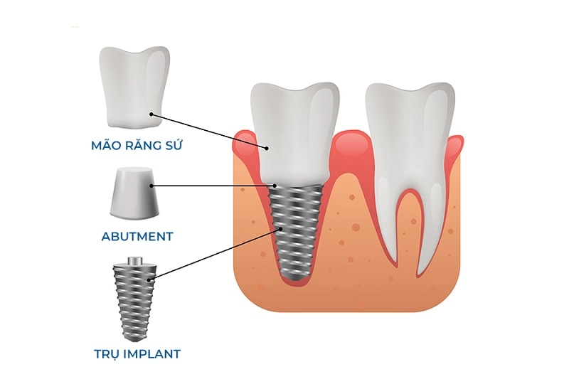 cấu tạo răng implant