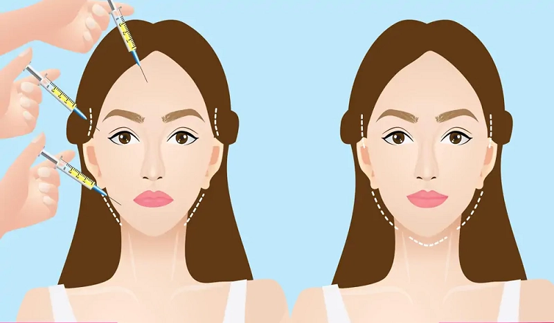 Cấy mỡ mặt rất phù hợp với những người có gương mặt gày, má/thái dương hóp...