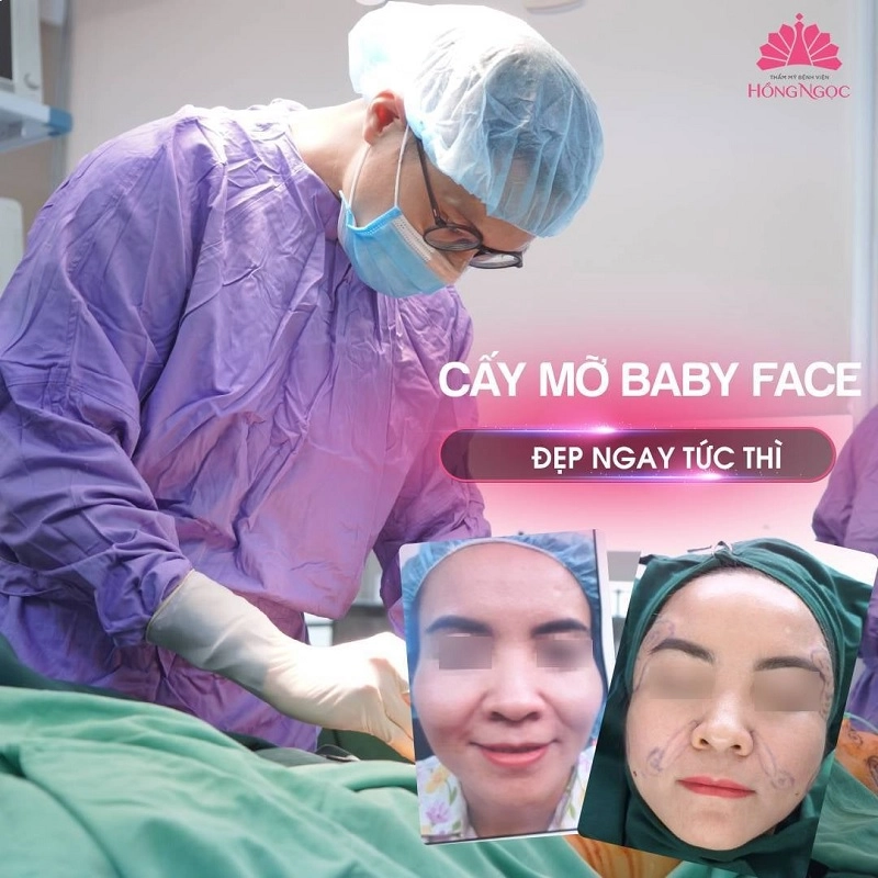 cấy mỡ baby face