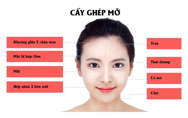 Cấy mỡ mặt giá bao nhiêu?