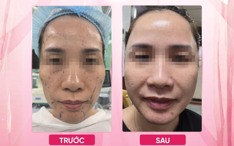 Cấy mỡ mặt có an toàn không?