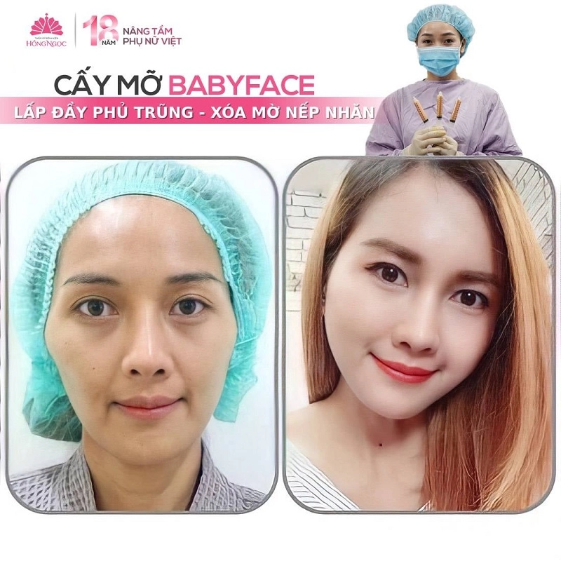 cấy mỡ mặt là gì