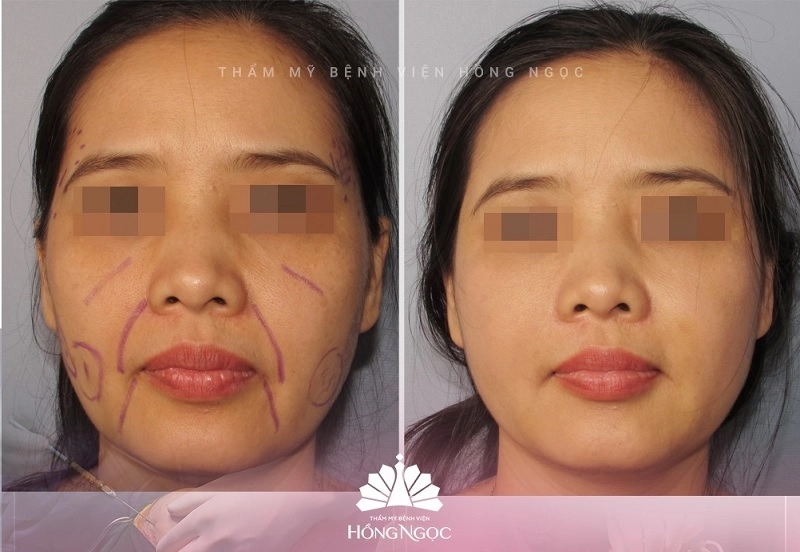 cấy mỡ mặt là gì