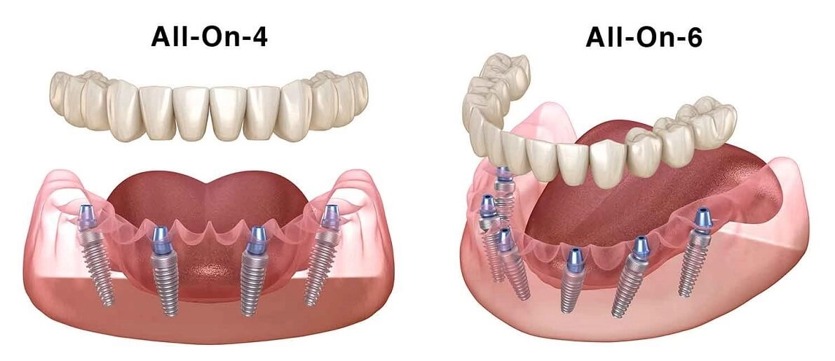Các yếu tố quyết định thời gian trồng răng Implant