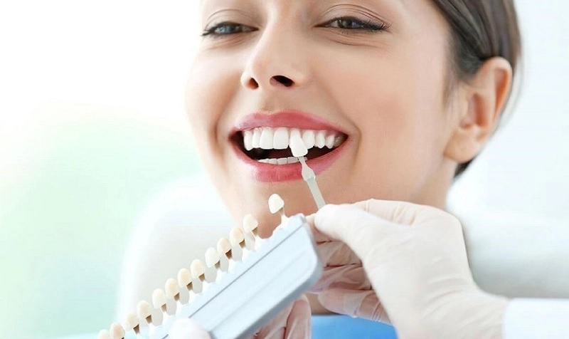 chăm sóc răng miệng sau khi dán sứ veneer emax