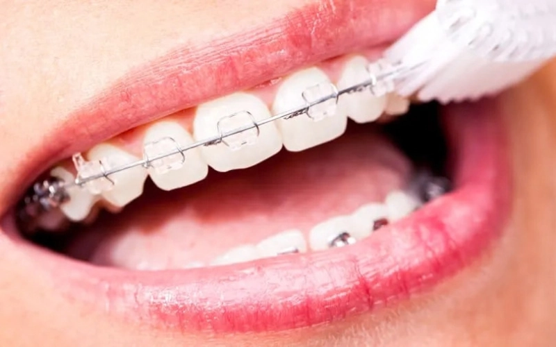 Những lưu ý khi niềng răng mắc cài sứ