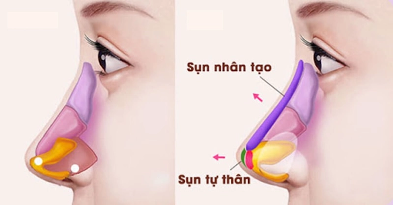chất liệu sử dụng nâng mũi