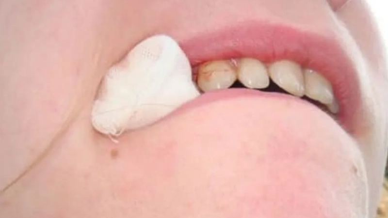 chảy máu khi nhổ răng 8