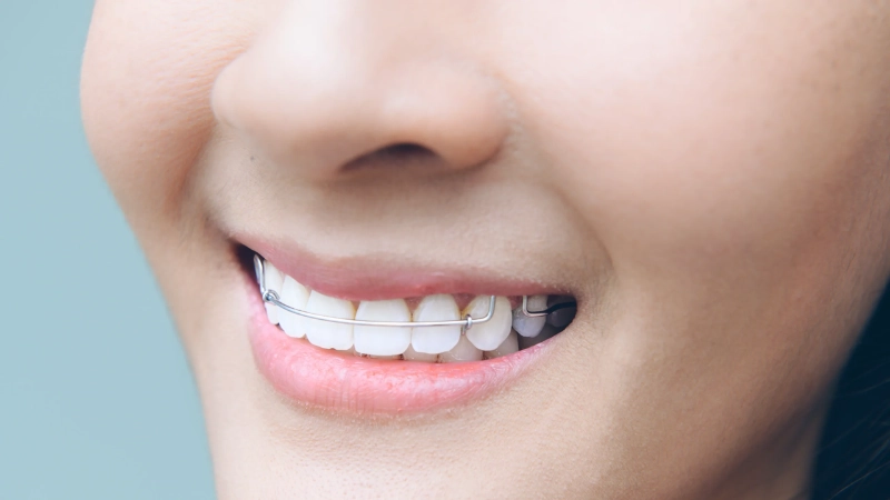 checklist những điều cần biết trước khi niềng răng