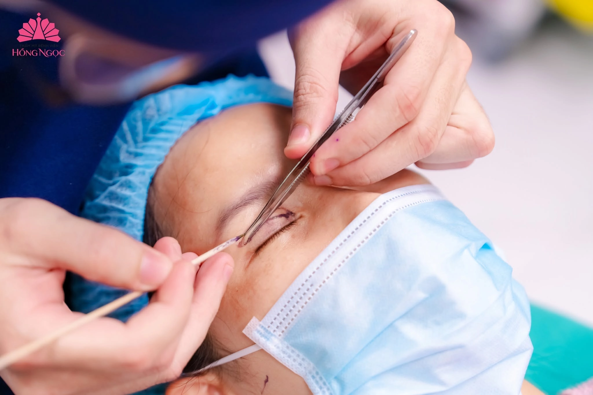 Chi phí cắt mí phụ thuộc vào cơ địa và tình trạng mí mắt