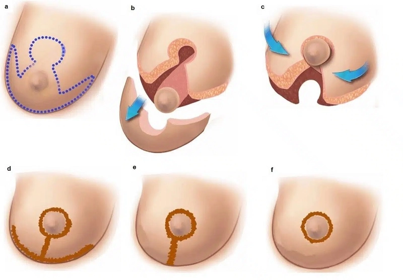 chi phí thu gọn ngực phì đại