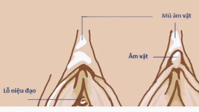 chỉnh mũ âm vật