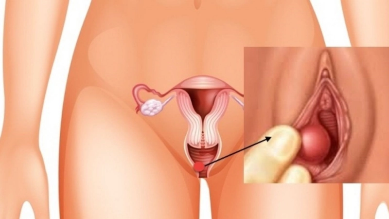 chỉnh mũ âm vật