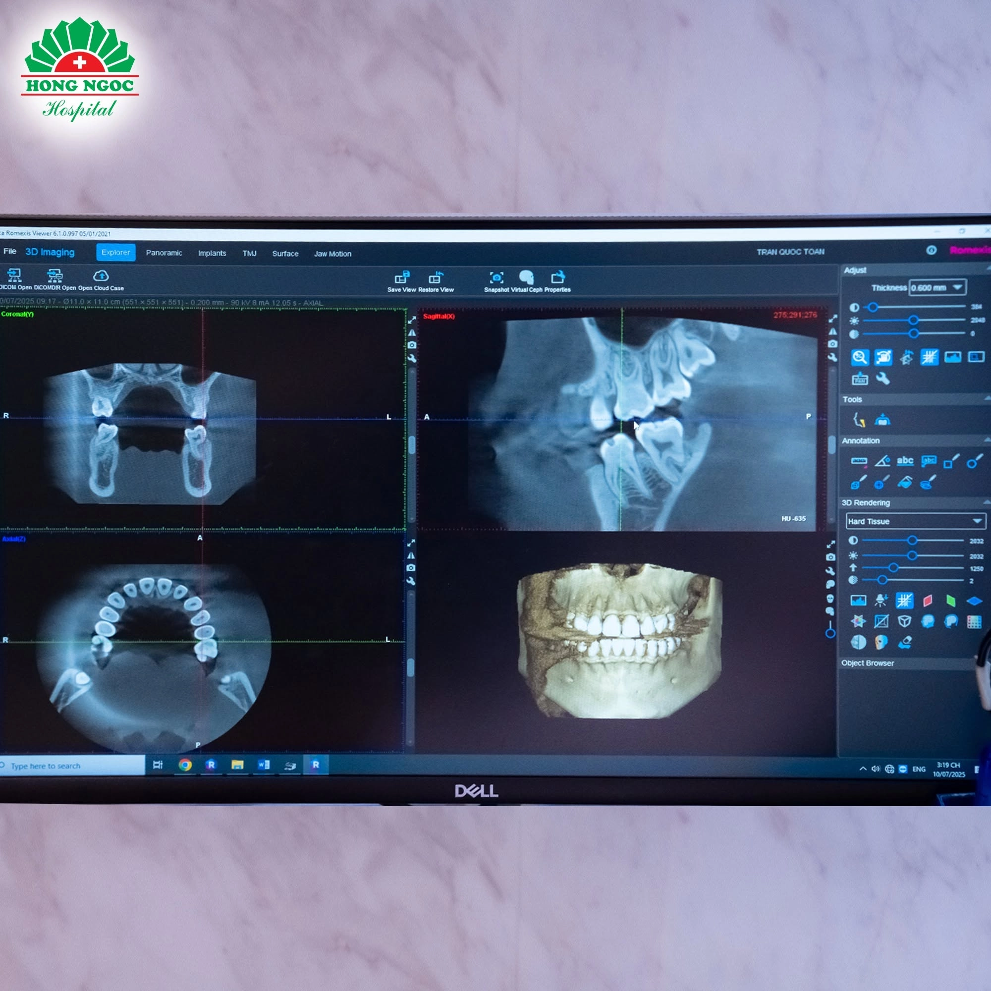 Quy trình chỉnh nha Invisalign tại Răng Hàm Mặt Hồng Ngọc