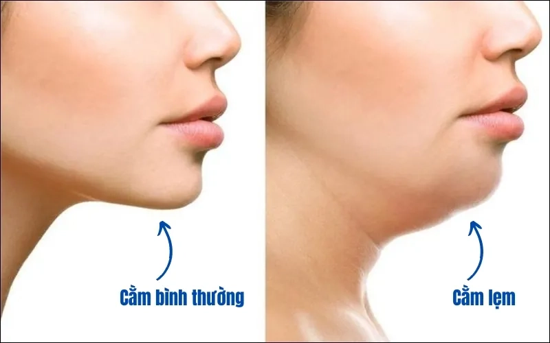 Độn cằm có an toàn không?